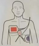 ZOLL CPR Stat-Padz électrodes